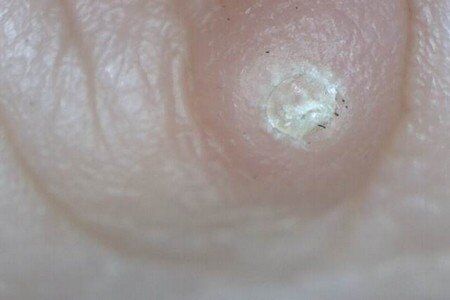 รู้เกี่ยวกับอาการหูดและการรักษาด้วยเคล็ดลับการป้องกัน