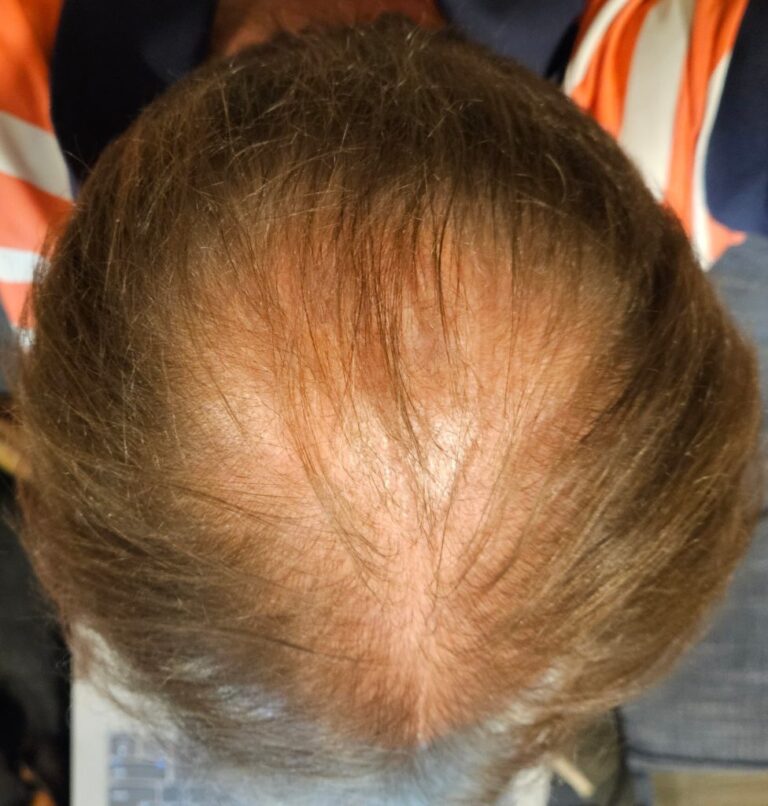 ค่าใช้จ่ายในการปลูกผม (อัปเดตหนึ่งปี)